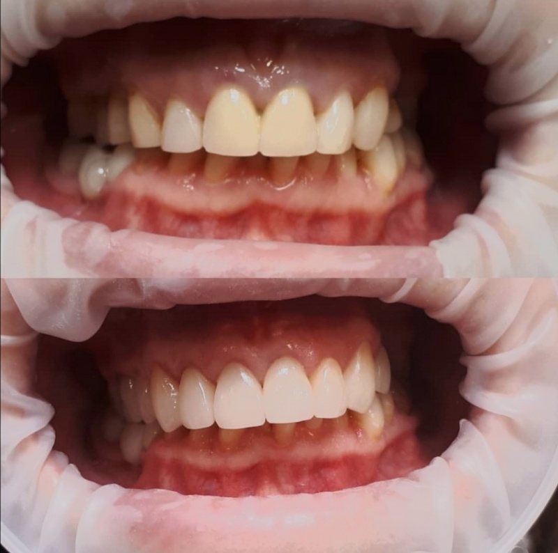 Удлинение коронковой части зубов + замена мк коронок и композитных реставраций на безметалловую реставрацию. Коркуц Т.И.
